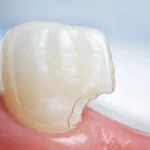 Dent cassée avec éclat visible — que faire en urgence chez le dentiste à Kénitra